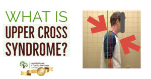 what is upper cross syndrome what is upper cross syndrome